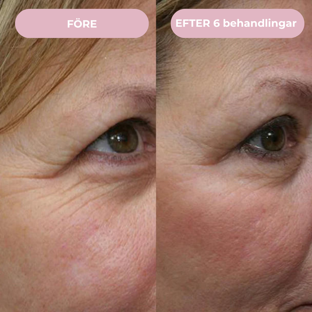 Glow Micro Infusion Kit™