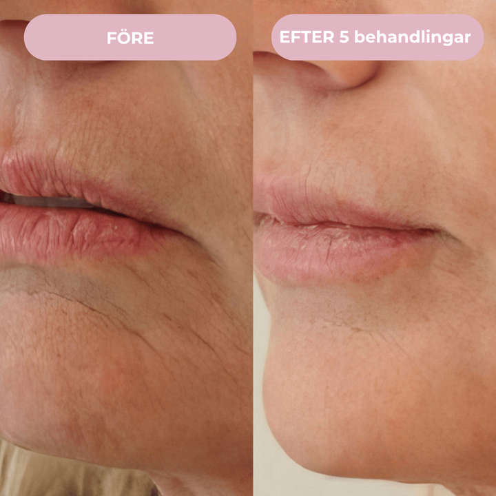 Glow Micro Infusion Kit™