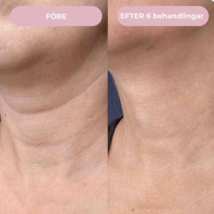 Glow Micro Infusion Kit™